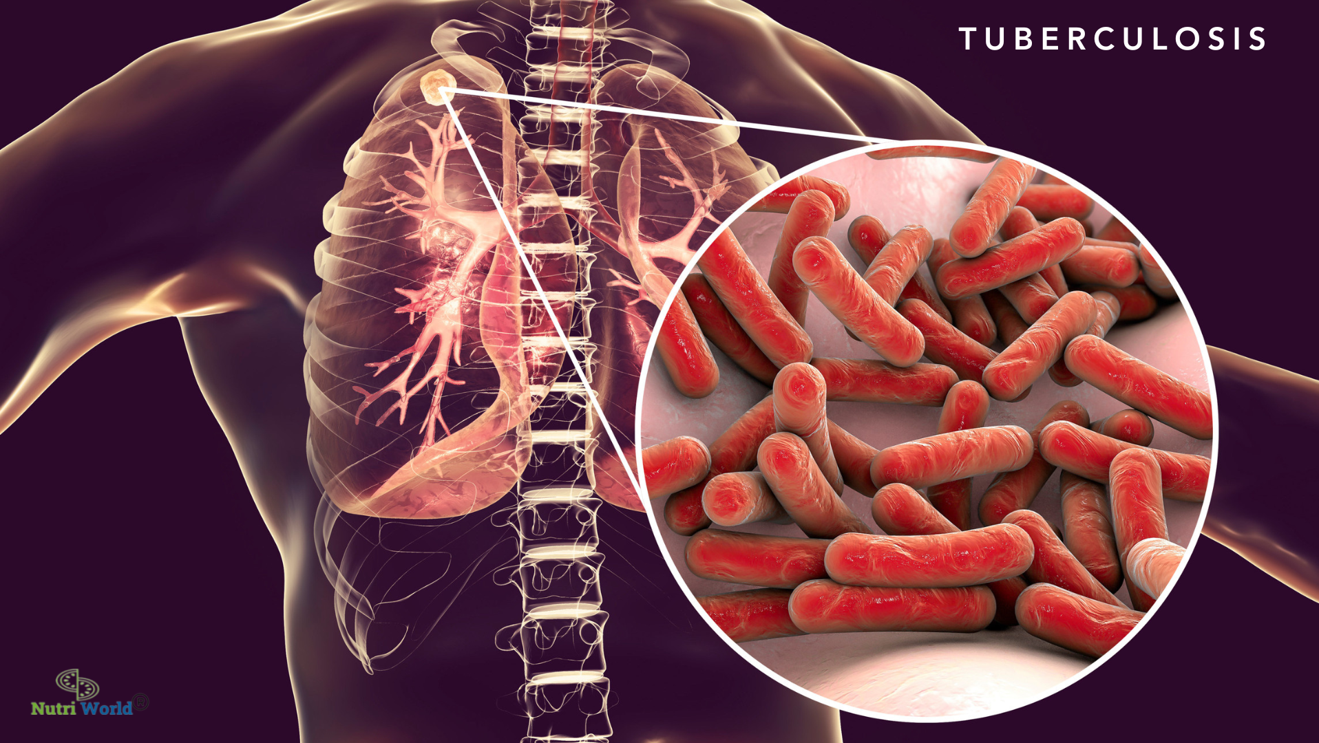 Nutrition and Tuberculosis: A Dietitian’s Guide to Supporting Recovery and Immunity - Nutriworld