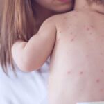 Nourishing Your Body: Diet Tips for Chicken Pox Patients