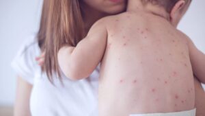 Nourishing Your Body: Diet Tips for Chicken Pox Patients